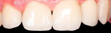 Estetica dentaria coroas sem metal coroas cerâmica