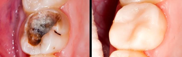 Estética dentária: restaurações indirectas (inlays, onlays) em resina ou cerâmica