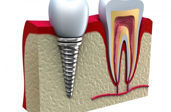 INSTRUÇÕES POST CIRURGIA PERIODONTAL E DE IMPLANTES