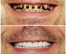 Prótese fixa: um pouco de paciência!