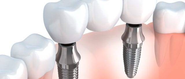 clinica dentaria jardim dos arcos implantes