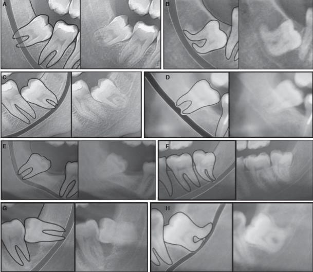 Exames usados para avaliar o grau de dificuldade da cirurgia para remoção de siso